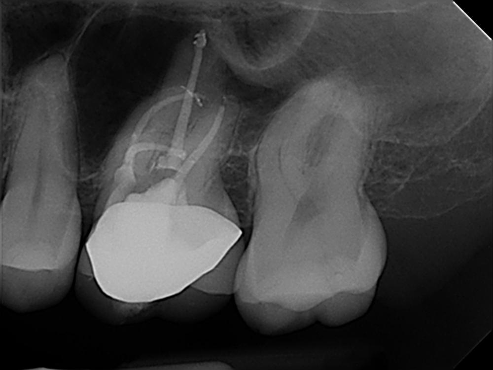 25_100635_Post-op1_.thumb.jpg.71dd19b0b810af11256aab665b3b1a94