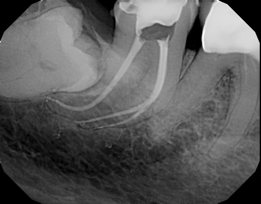 Tooth #31 cleaned and shaped with Edge File X7 .04 taper. 