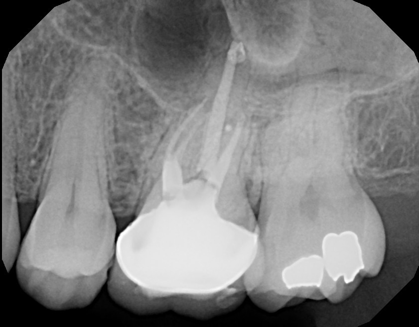 Tooth #14 completed showing file removed and MB and MB2 obturated.